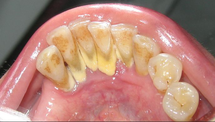 Nguyên nhân gây chính gây răng