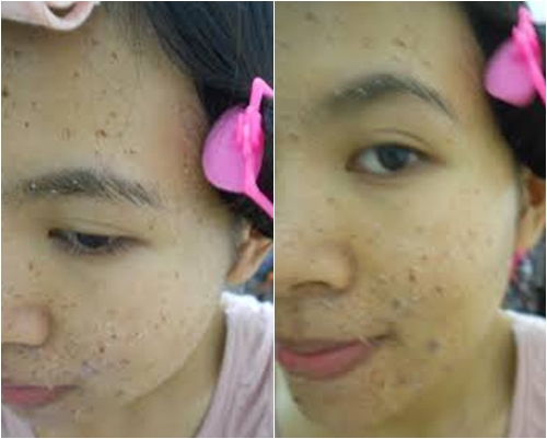Kinh nghiệm trị mụn dứt điểm chỉ trong 2 tuần