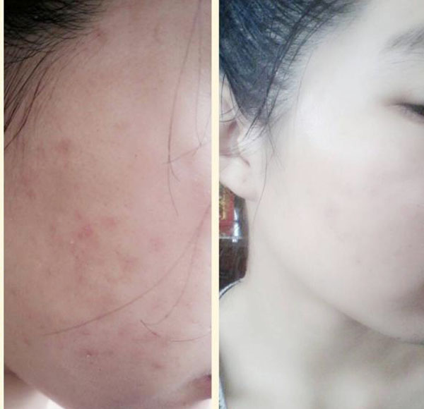 Kinh nghiệm trị mụn dứt điểm chỉ trong 2 tuần Kinh nghiệm trị mụn dứt điểm chỉ trong 2 tuần