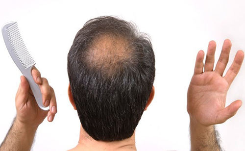 Tóc hói, tóc rụng có thể khắc phục chỉ với lô hội - 2