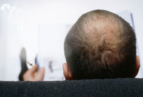 Những thói quen gây rụng tóc, hói đầu ở nam giới - 3