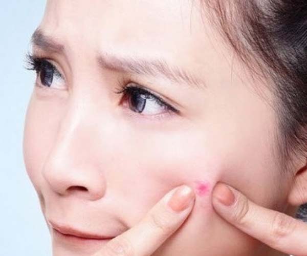 Dầu jojoba điều trị mụn sẹo tốt nhất