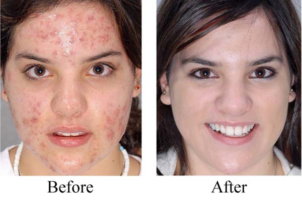 Dầu jojoba điều trị mụn sẹo tốt nhất