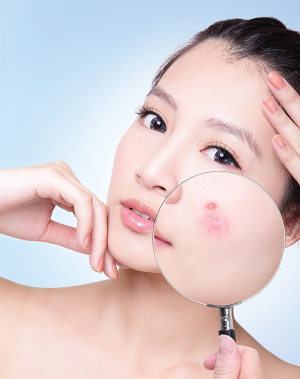 Các loại mụn thường gặp và cách nhận biết