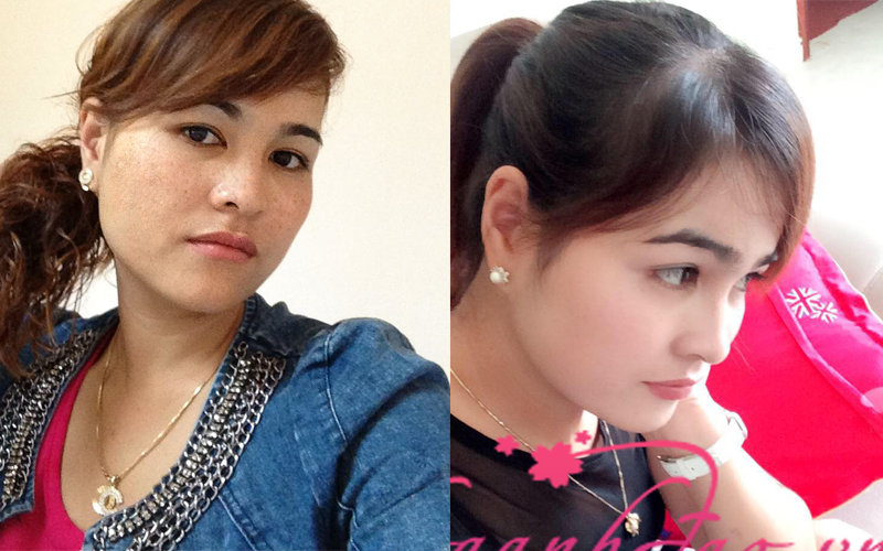 Khách hàng đã điều trị nám thành công