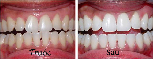 Cách 1: Muối và nước cốt chanh