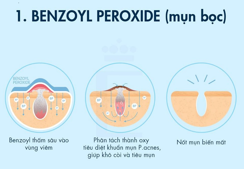 benzoyl-peroxide-tri-mun-sung-viem-an-toan-va-hieu-qua-1