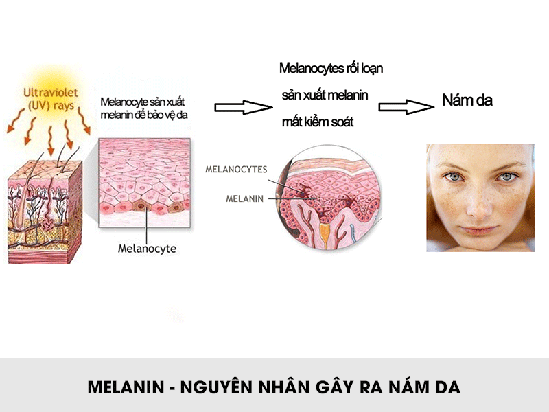 Melanin – nguyên nhân gây nám da
