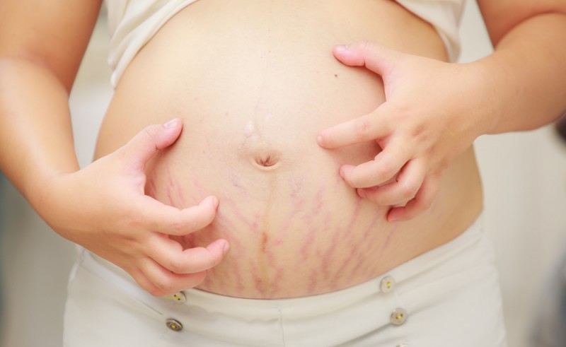 Curcumin giúp làm mờ vết rạn da do tăng cân đột ngột khi mang thai
