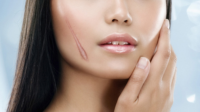Tinh dầu nụ tầm xuân còn có khả năng chữa giảm sẹo cũng như vết chàm trên da