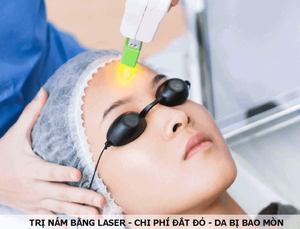 tri-nam-bang-laser-123