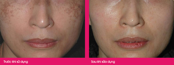 Hiệu quả trước và sau khi sử dụng Serum trị nám Nanoluxe Reluma MD