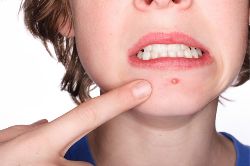 Những nguyên nhân gây mụn trứng cá mà bạn không thể ngờ