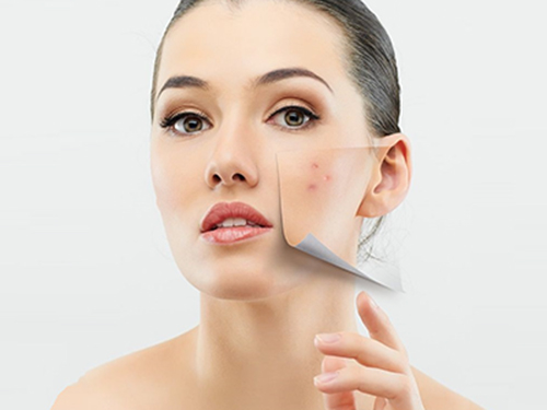 Da sạch mụn đầu đen nhờ 5 nguyên liệu tự nhiên
