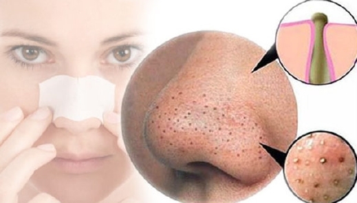 Khắc phục làn da mụn bằng tảo biển