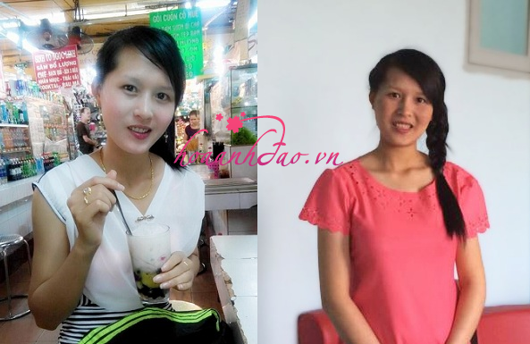 Hình ảnh trước và sau khi giảm nám thành công của chị Trần Thị Thúy