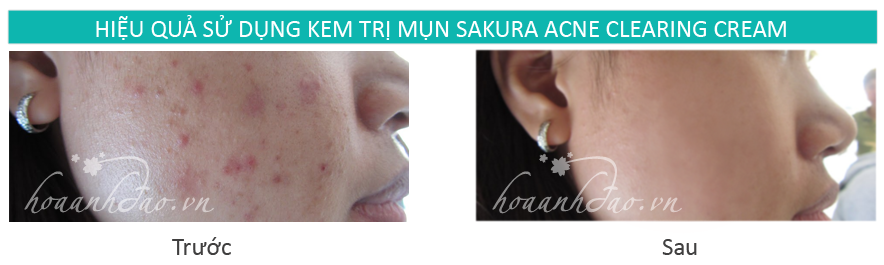 Trị mụn tận hiệu quả bằng tía tô