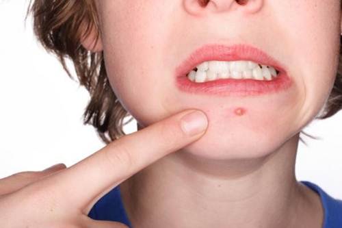 trị mụn trứng cá