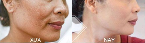 Nám lâu năm ăn sâu vào da và sậm đen vẫn đễ dàng được loại bỏ