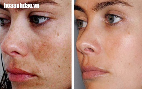 Nám da, đốm nâu mờ hơn 95‰, da sáng mịn trông thấy rõ sau liệu trình giảm 25 ngày của phụ nữ châu Âu