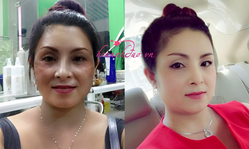 Không thể phủ nhận mình có trang điểm, nhưng chỉ là lớp kem nền nhẹ. Nám trên da mình đã giảm 95‰ mọi người nhé