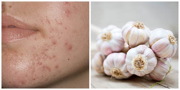 Trị mụn để đón Tết chỉ sau 5 ngày từ tỏi