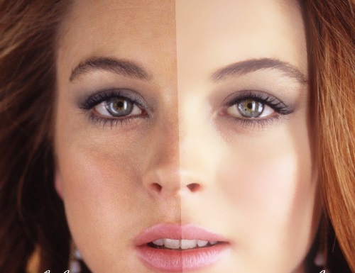 Da bị tàn nhang và nám