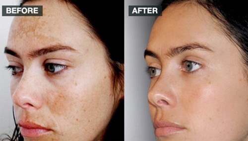 Cải thiện tình trạng nám da một cách nhanh chóng