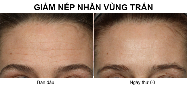 may-massage-nang-co-mat-Nuface-Trinity