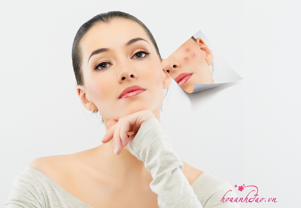 3 cách trị sẹo thâm đơn giản tại nhà