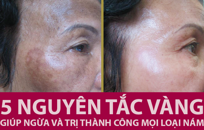 Thuộc ngay 5 nguyên tắc bất di bất dịch để da không bị nám!