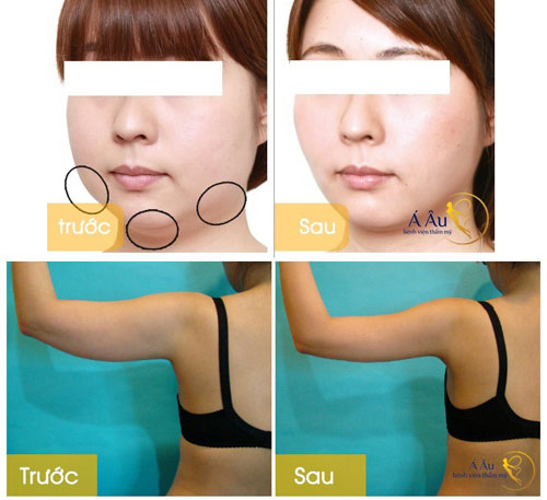 Hủy mỡ toàn thân tạo dáng hình chữ S