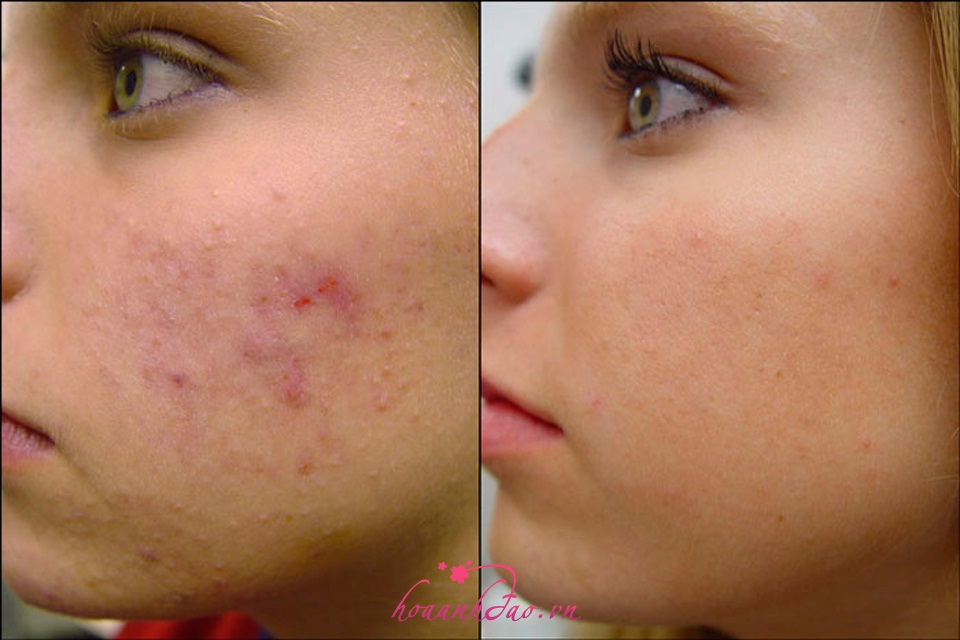 Trị mụn trứng cá và vết thâm trong 2 tuần