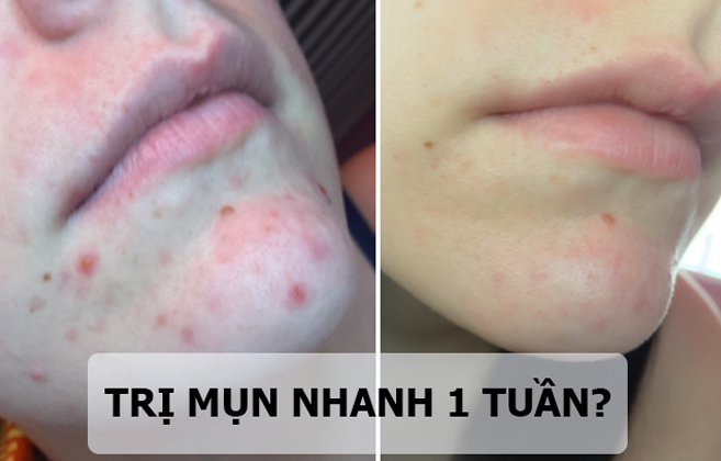 Phát hiện bất ngờ giúp trị mụn trong nháy mắt