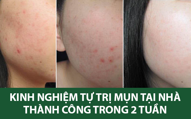 Chia sẻ kinh nghiệm tự trị mụn, xóa thâm thành công chỉ trong 2 tuần!