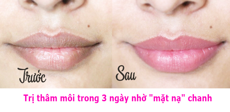 Trị thâm môi trong 3 ngày nhờ "mặt nạ" chanh