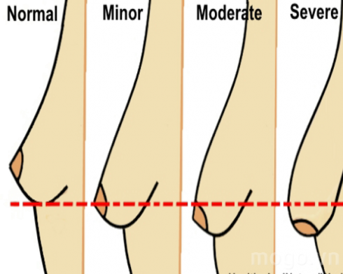 “Nâng cấp” bộ ngực chảy xệ ngay lập tức bằng 3 công thức đơn giản tại nhà
