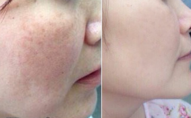 Nám lâu năm, nám nội tiết, áp dụng ngay phương pháp này để sạch boong nám!