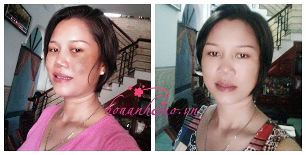 Xóa sạch nám, sau 5 năm chữa hoài không khỏi