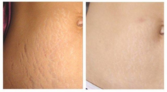 Công thức trị rạn da cho bà bầu chỉ sau 2 tuần với bã cà phê xay