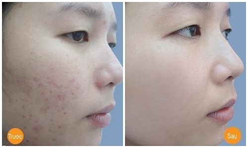 Hỗn hợp cực rẻ, cực an toàn giúp đánh bay vết thâm chỉ sau 2 tuần