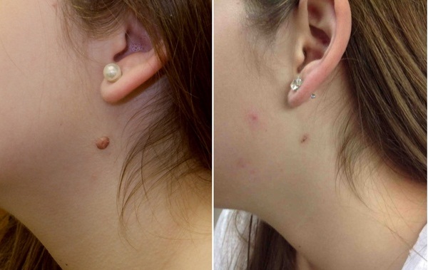 Cách trị mụn cóc, mụn cơm với giấm táo không để lại sẹo