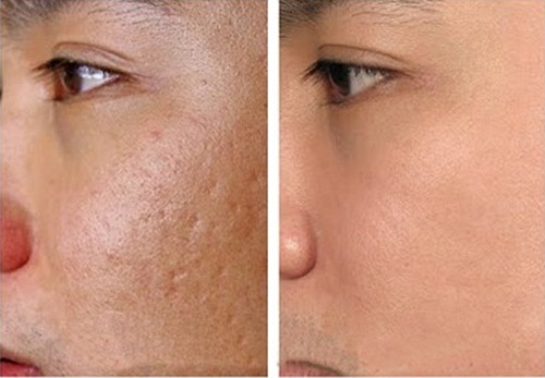 Trộn đu đủ với thứ này, sẹo lõm lâu năm thế nào cũng bị xóa mờ 80%