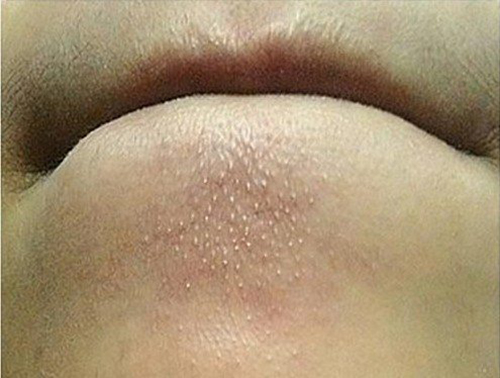 Cách trị mụn tại nhà có hiệu quả nhanh nhất