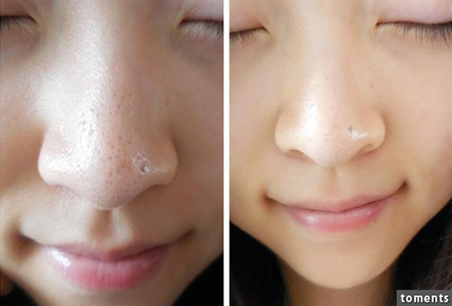 Cách trị mụn đầu đen ở mũi nhanh và hiệu quả nhất