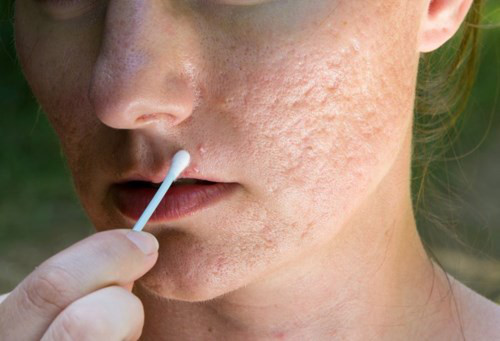 3 công thức trị khỏi “sẹo lõm” hiệu quả cao dù đã bị cả chục năm