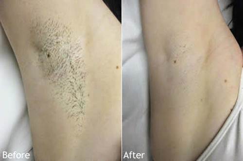 Nách thâm đen, sần sùi hay có mùi đến đâu cũng phải khỏi ngay tức khắc chỉ bằng 1 quả chanh