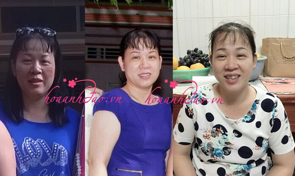 Lướt facebook, gặp "đúng thầy đúng thuốc" trị sạch sành sanh nám 10 năm chị em ạ!