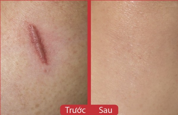 Rửa mặt với nước chè xanh khoảng 10 phút mỗi ngày, sẹo lồi, sẹo thâm cũng phải biến mất