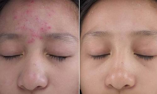 Giúp da vẫn láng mịn, trắng đẹp và không 1 nốt mụn